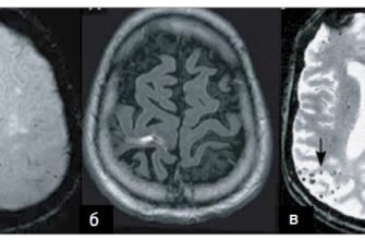 Лікування Хвороби Бінсвангера: Сучасні Підходи та Методики