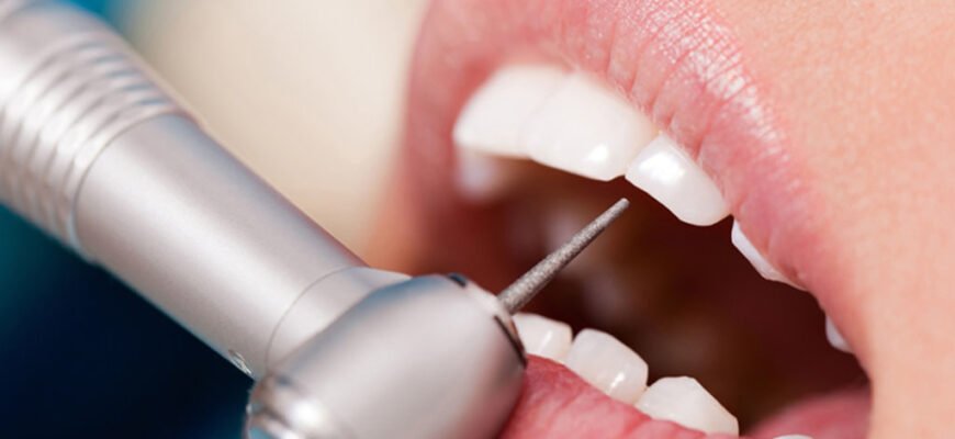 Чем опасен кариес: почему лучше не запускать проблему