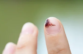 Що таке меланома та як її виявити