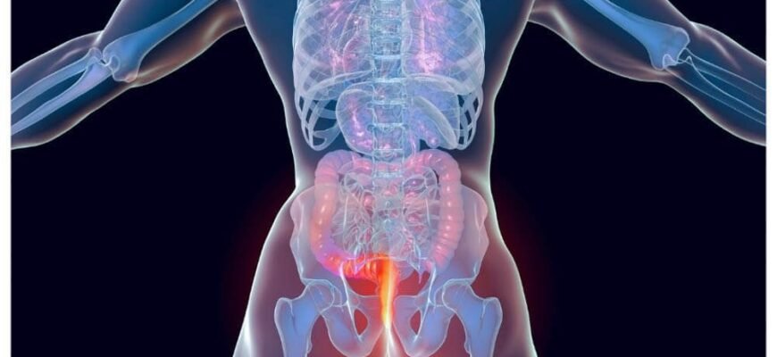 Випадіння прямої кишки: причини, симптоми та сучасні методи лікування