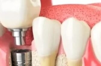 Протезирование зубов без компромиссов: функциональность, эстетика и психология улыбки