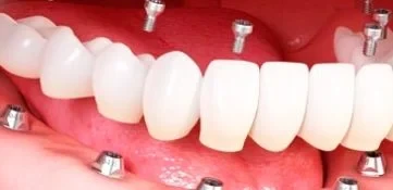 Протезирование зубов