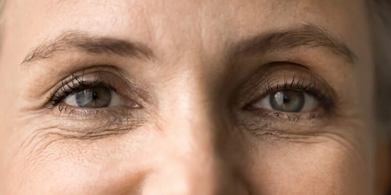 От чего зависит стоимость блефаропластики и почему опускаются нижние веки?