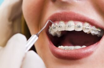 Скільки коштує встановити брекети у Львові