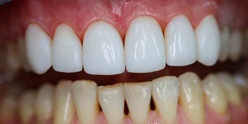 Виниры: как понять, подходят ли они именно вам