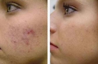 Як лікувати акне Дифферин гелем: склад, механізм дії та правила нанесення