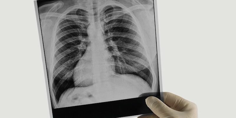 Флюорографія у пакеті документів: коли потрібне підтвердження обстеження